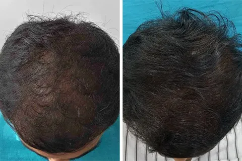 Hair rejuvation therapy before photo in VCare